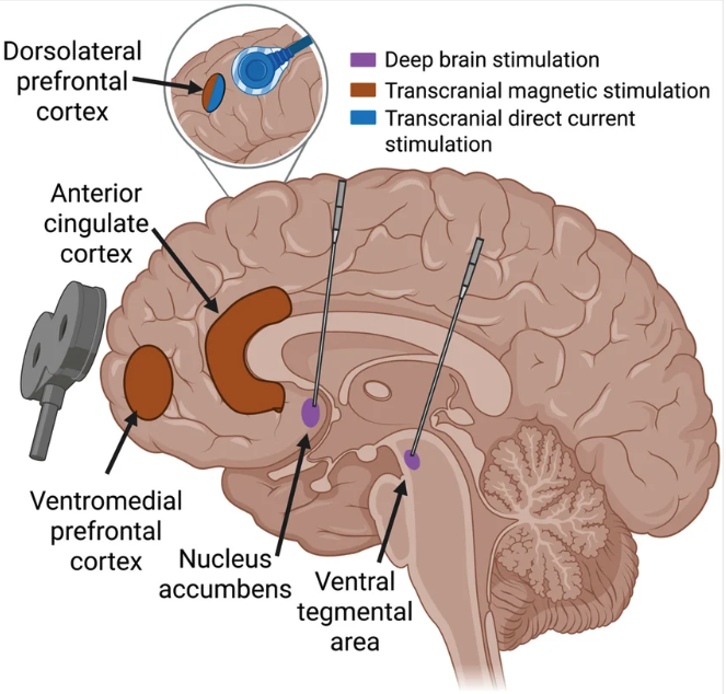 Illustrative representation of brain and its different regions as targeted by TMS therapy